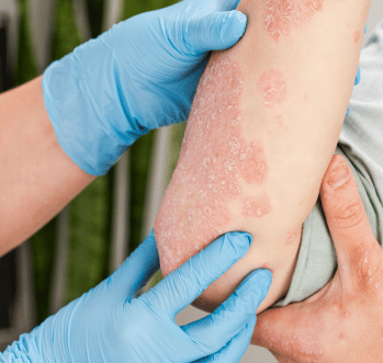 Autoimmunity